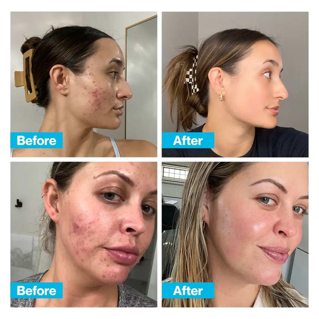 CLEARSKIN™ - Image 4